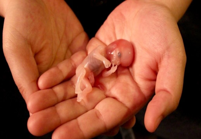 L'avortement jusqu'à la naissance : le révélateur de la morbidité de notre société ?